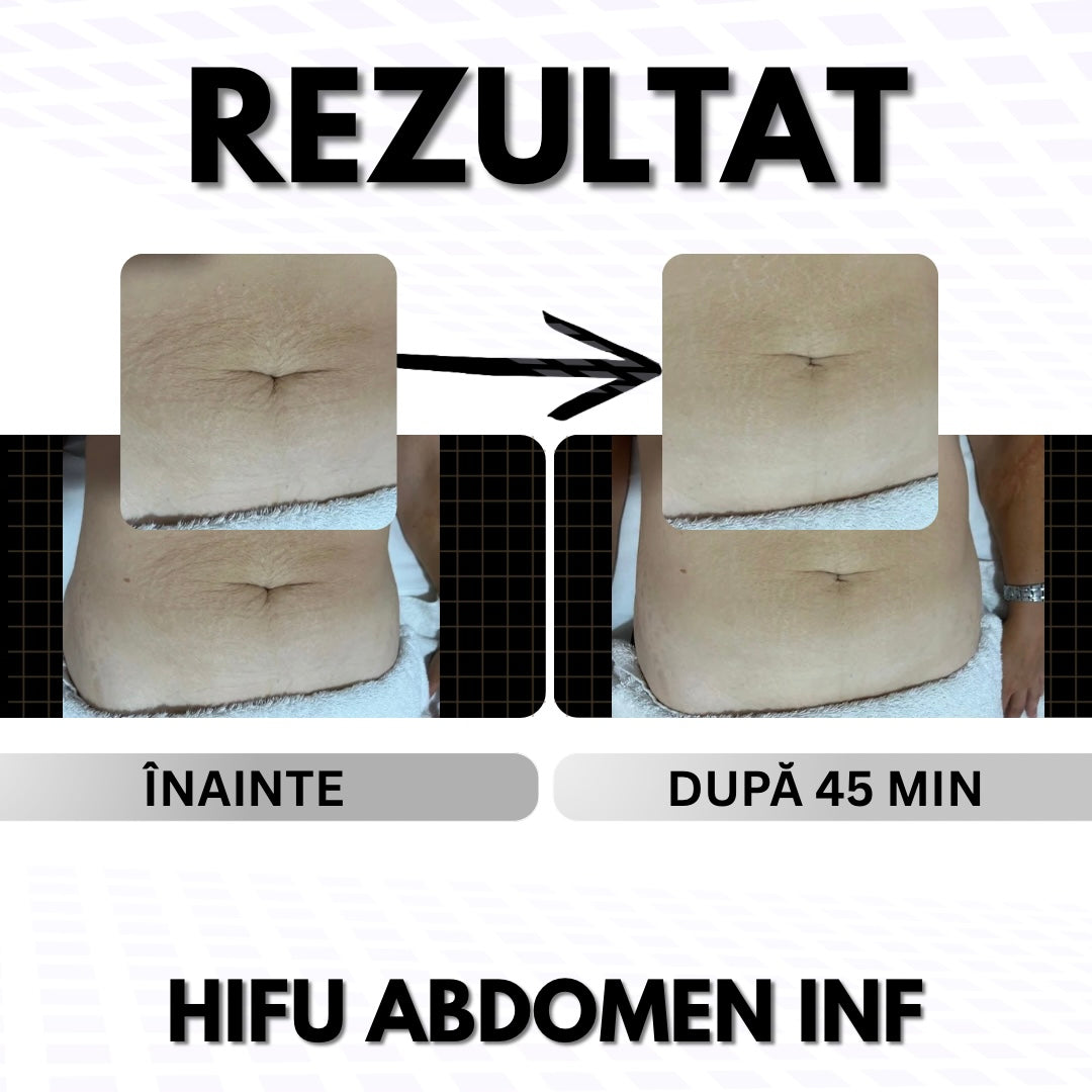ABDOMEN - Pentru Grăsime / Piele Lăsată 👉