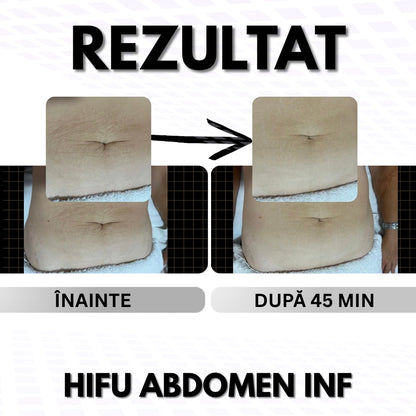 ABDOMEN - Pentru Grăsime / Piele Lăsată 👉