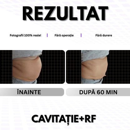 ABDOMEN - Pentru Grăsime / Piele Lăsată 👉