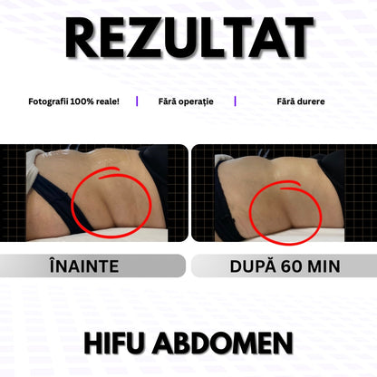 ABDOMEN - Pentru Grăsime / Piele Lăsată 👉
