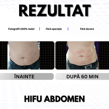 ABDOMEN - Pentru Grăsime / Piele Lăsată 👉