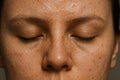 Sebum Off Protocol