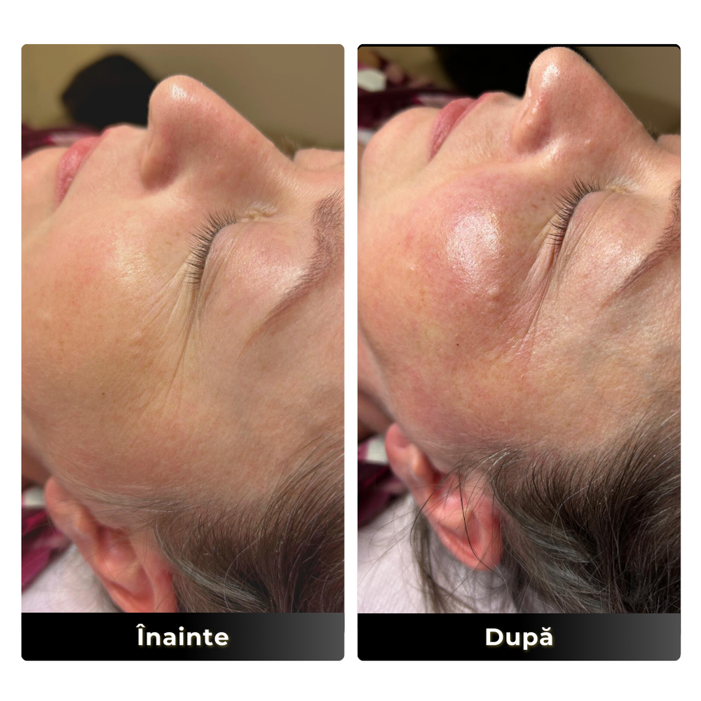 Ten glow before after