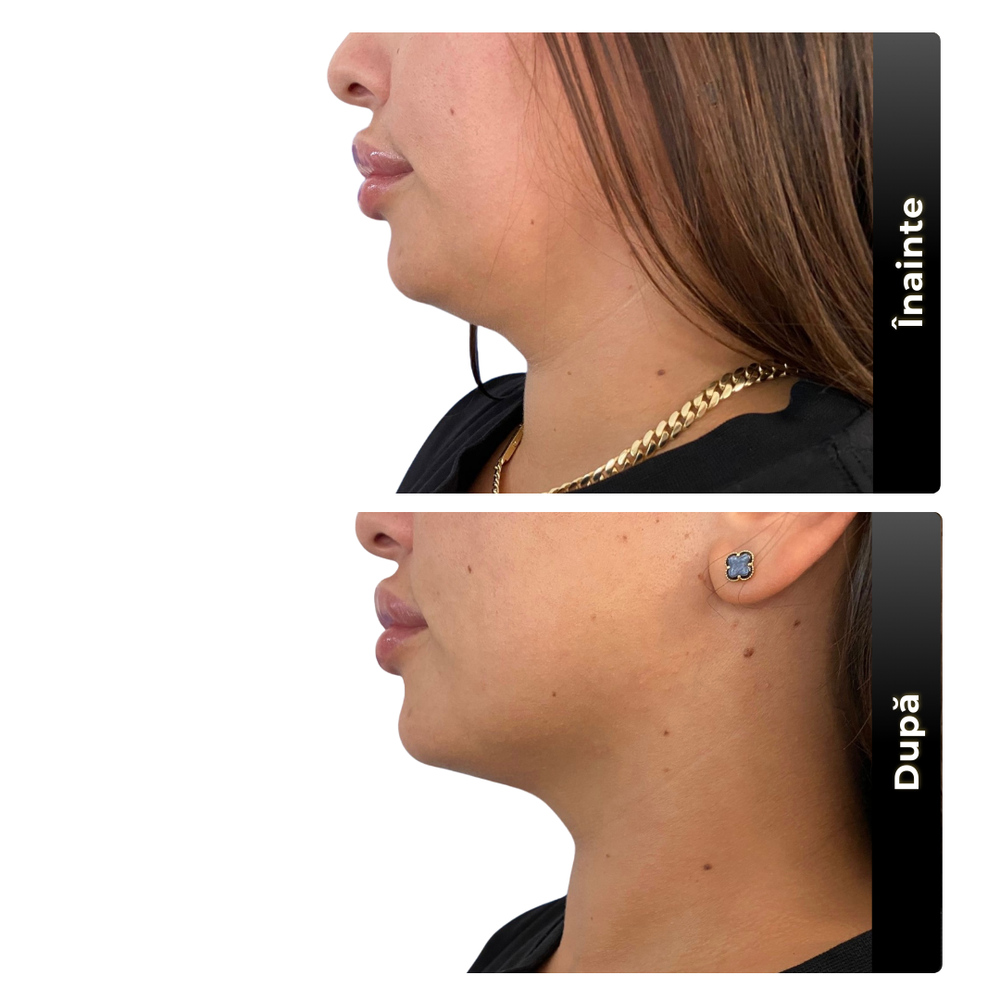 Lifting facial before after