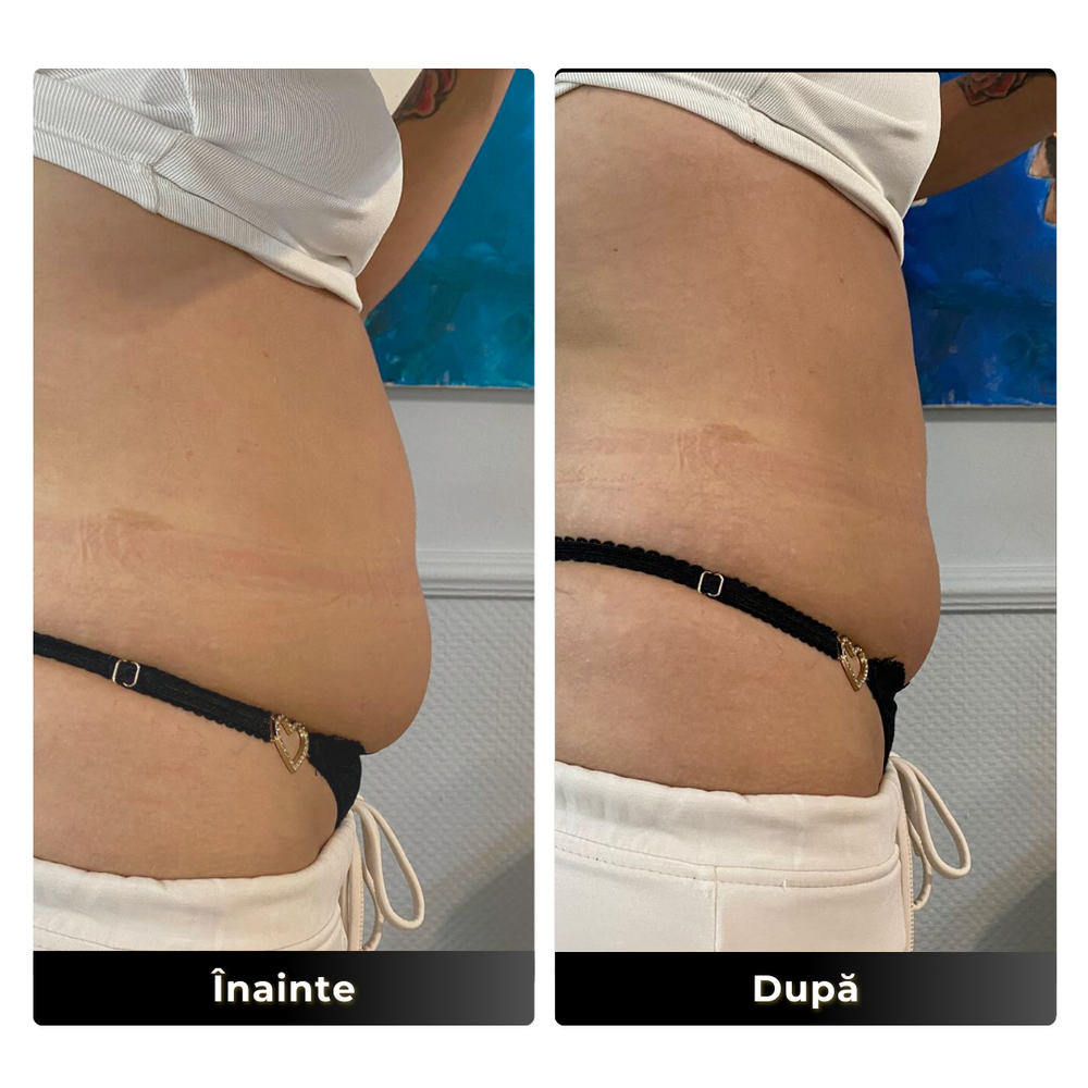 Remodelare corporala before after