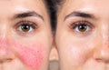 Redness Relief Protocol